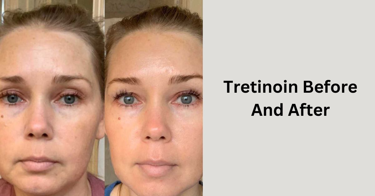 Tretinoin Before And After